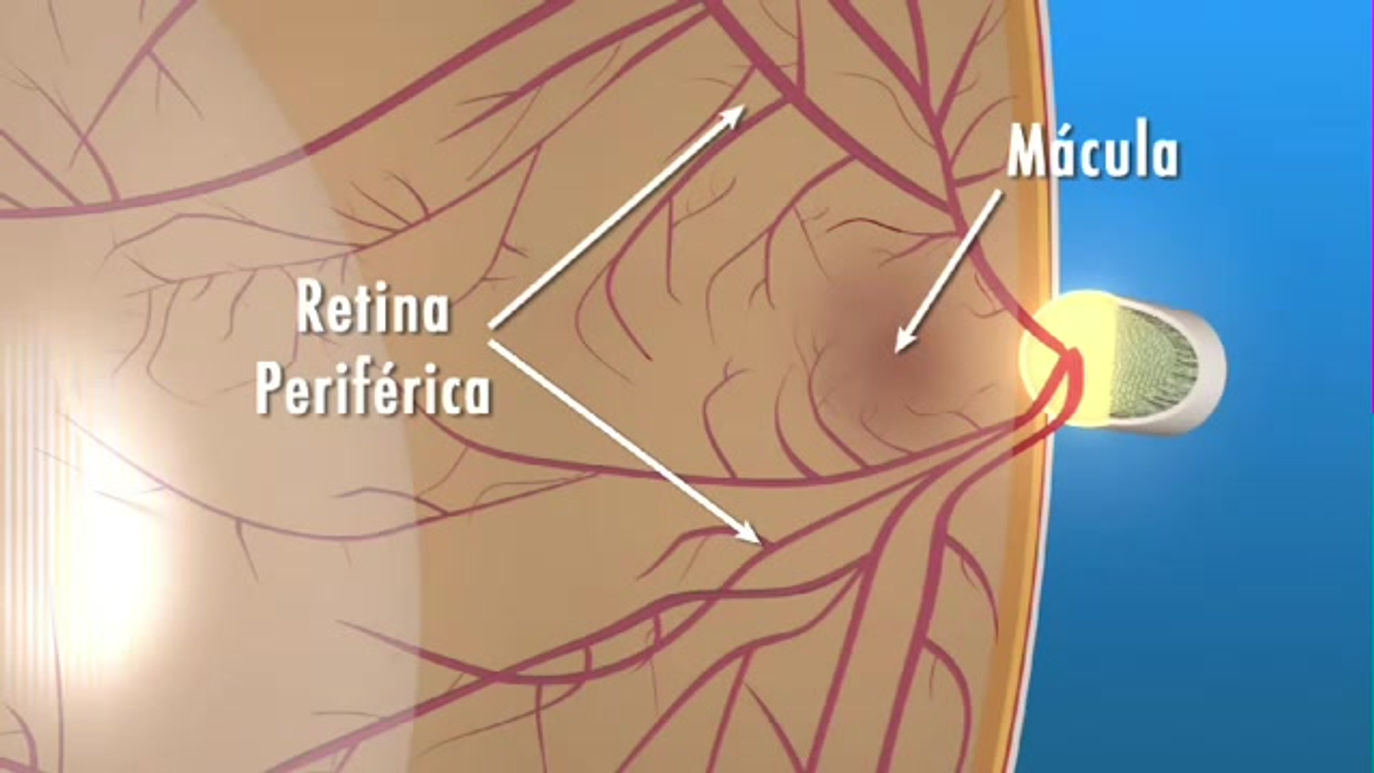 DEGENERACIÓN MACULAR